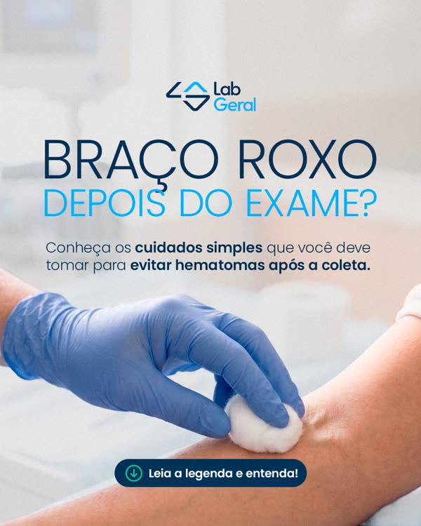 Post do LabGeral: braço roxo depois do exame? Cuidados simples para evitar hematomas após a coleta.